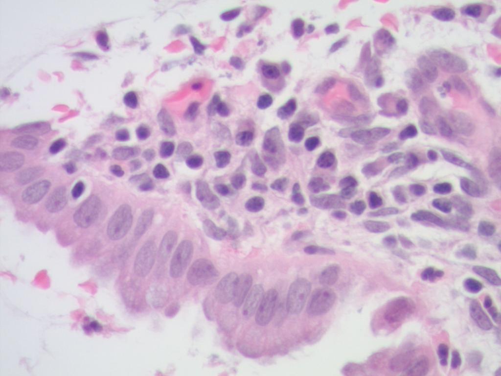 epithelium of the cervix into the upper stroma. This includes both the glandular endocervical and squamous exocervical tissue and stromal tissue.
