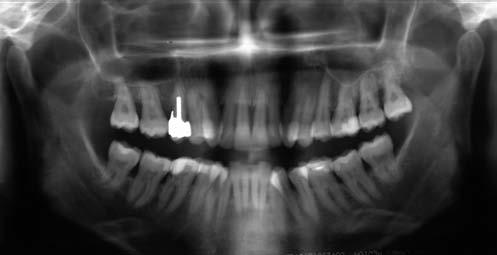a c d e Fig 3a. Pre-operative radiograph. The patient had generalized refractory periodontitis, especially in the maxillary arch. Fig 3. Pre-operative facial view.