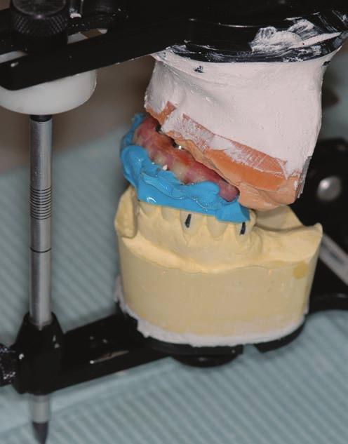 The denture flange was then trimmed and the fitting surface was adjusted to allow proper hygiene. Fig 5d. The provisional hyrid was used as verification jig over the master cast.