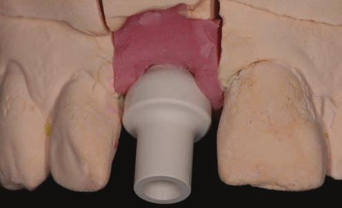 A screw retained provisional crown was made at chairside from the patient s existing partial denture, attached to the temporary cylinder using additional self cure resin.