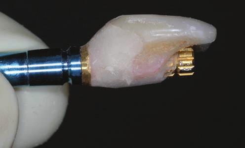 Facial view of screw retained provisional restoration on tooth 11 site. The provisional restoration was hand tightened.