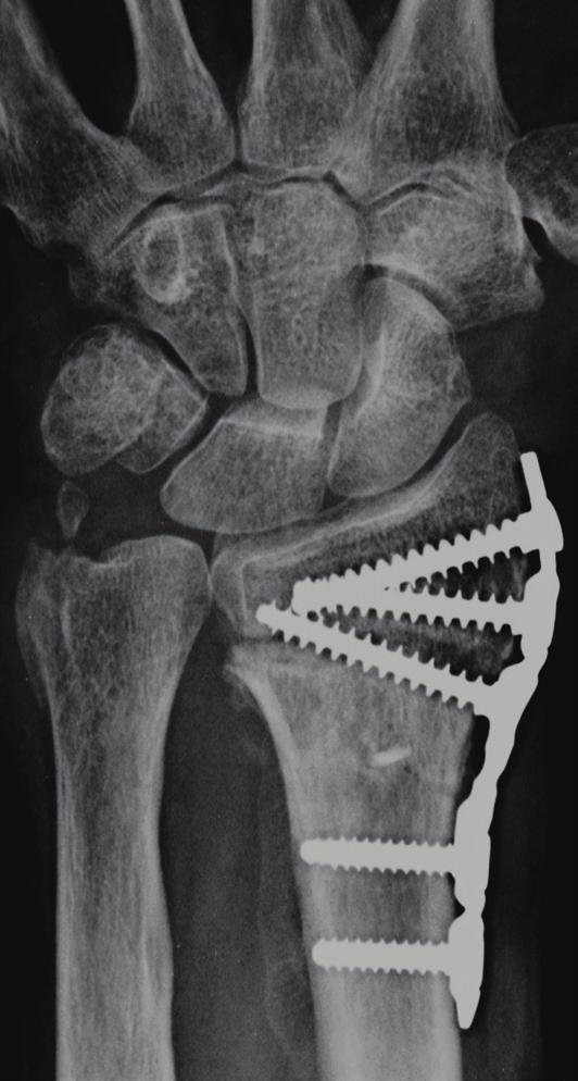 In 2009, he and his fellow investigators compared functional outcomes among patients with unstable distal radius fractures surgically repaired with external fixation (22 patients) (Fig.