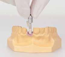 Individualize the 3 temporary abutment.