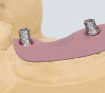 6 Shorten the temporary abutment and then check the heights with the silicone key
