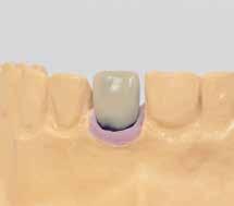 TITANIUM ABUTMENT CEMENTED RESTORATION 1 Fabricate the master cast including a gingival 2 mask.