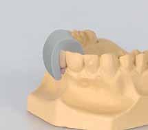 3 Make a silicone key over the full wax-up in order to define the optimal shape of the customized titanium abutment.