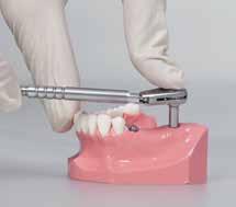 BRIDGE SCREWABLE PROSTHESIS TAKING IMPRESSION 1 Position the multiuse abutments in the