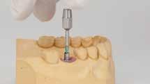 (implant and abutment), that combined with