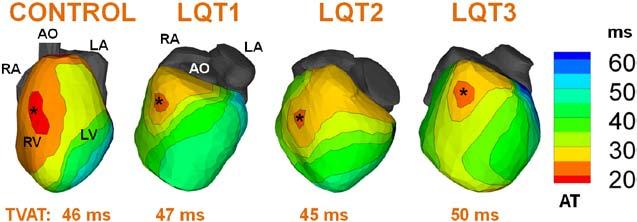 Vijayakumar et al ECG Imaging of EP Substrate in Human LQTS 1939 Figure 1. Epicardial activation time (AT) isochrone maps.