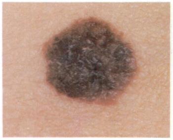 Fig. 21. Progression of malignant melanoma. plaque. 5_,JllIIJHhIJ IIlifi 111,11 1IIIUIIIIIIIIII I1J 1 2 3 â PZCJME@ Fig. 22. Progression of malignant melanoma: plaque with nodule tional risk factors.