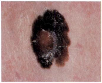 5â Examination of the Skin: The First Step towards Diagnosis Unlike other cancers, which are generally hidden from view, malignant melanoma, as Dr.