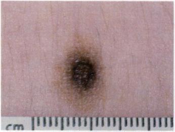 52 Similarly, if malignant melanomas are to be identified when they are curable, complete and thorough examinations by physicians should be encouraged and taught, supplemented by frequent self