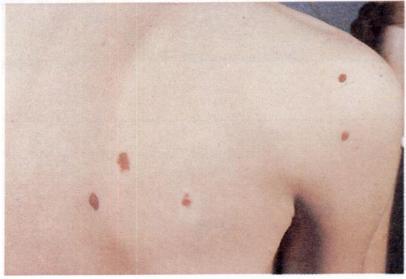 â A Fig. 31. Photograph of patient with multiple dysplastic nevi.