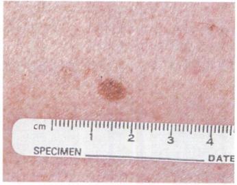 â _@_ DATE Fig. 3. Junction nevus. Sharply defined tan to brown macule. this tumor and thorough knowledge of: e The clinical characteristics of early ma lignant melanomas.