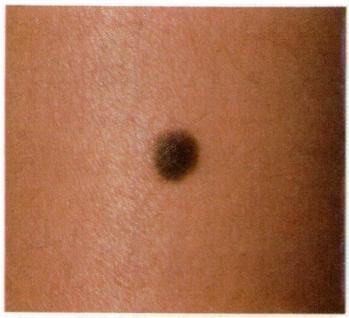 circumscribed, small (less than six mm), raised papule that is uniformly pigmented with a range of color from skin-colored to tan to shades of brown and a smooth or rough surface.