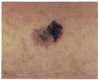 However, any new pigmented lesion on the skin that de velops after age 403 and does not meet the criteria set forth for benign p'igmented lesions should be suspected of being a ma lignant melanoma or