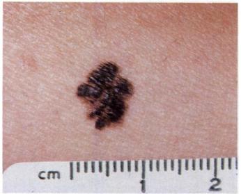 Border irregularity of early malignant melanoma. remembered by thinking of ABCD: â A = Asymmetry. â B = Border irregularity. â C = Color variegation. â D = Diameter generally greater than six mm.