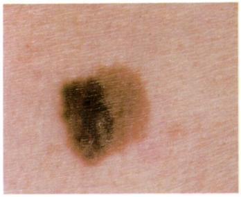 Fig. 14. Color variegation of early malignant melanoma. Note nuances of tans and browns. Fig. 15. Color variegation of early malignant melanoma. tected areas like the breasts, pubic area, buttocks, and scalp.