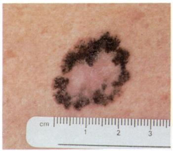 dysplastic nevi or malignant melanomas.