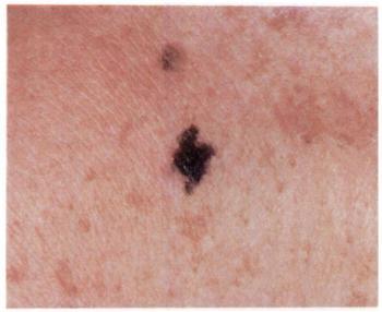â I of malignant melanoma approaches a re ported 100 percent for those patients with dysplastic nevi who have both two or more first-degree relatives with cutaneous ma lignant melanomas and two or