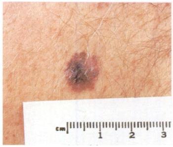 Early malignant melanoma, approxi mately six mm in diameter..1 @;4J.@,@;. <â ;4i - FIg 19 Early malignant melanoma, approxi mately eight mm in diameter.