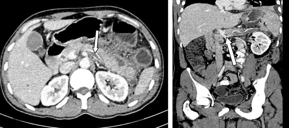 (, nd c) Axil CECT venous phse imge shows hypottenuting collection suggestive of pseudo cyst formtion nterior to the pncres (long rrow, ).