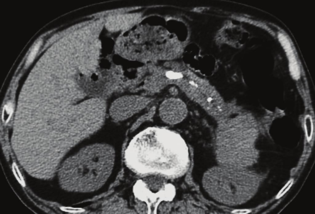 International Rheumatology 3 (a) (b) Figure 1: CT of AIP showing definite imaging findings. (a) Stones in pancreatic ducts.