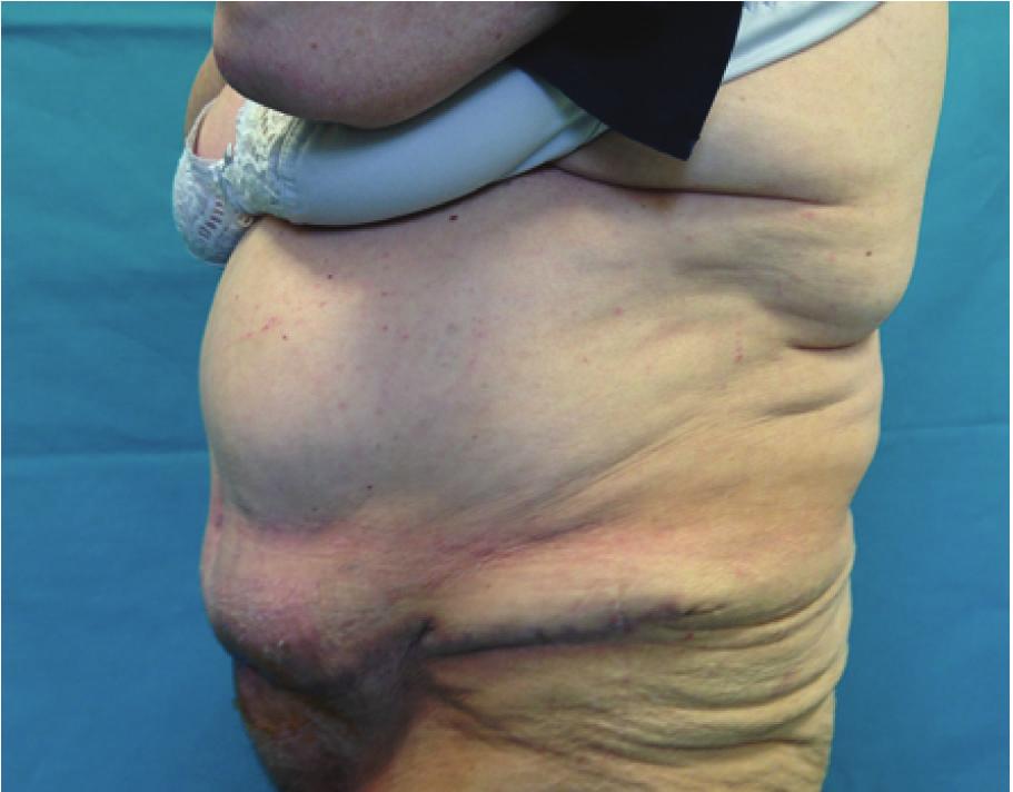 Following skin resection and reinsertion of the umbilicus, skin closure was performed with absorbable monofilament (Vicryl 2/0 and 3/0 Monosyn).