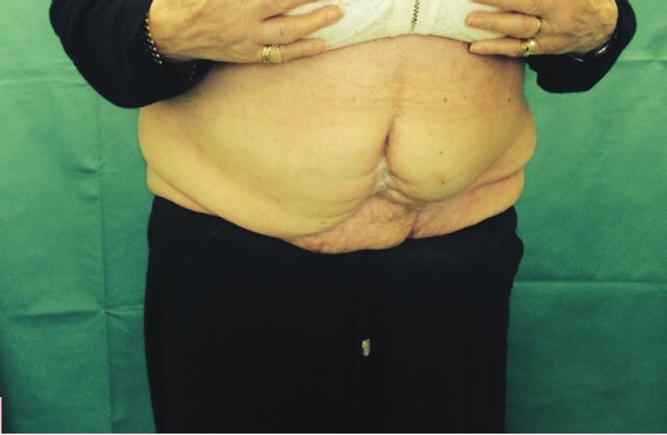 Considering the increasing popularity of abdominoplasty, there is renewed focus on technical refinements, not only to improve postoperative appearance but also to reduce postoperative complications.
