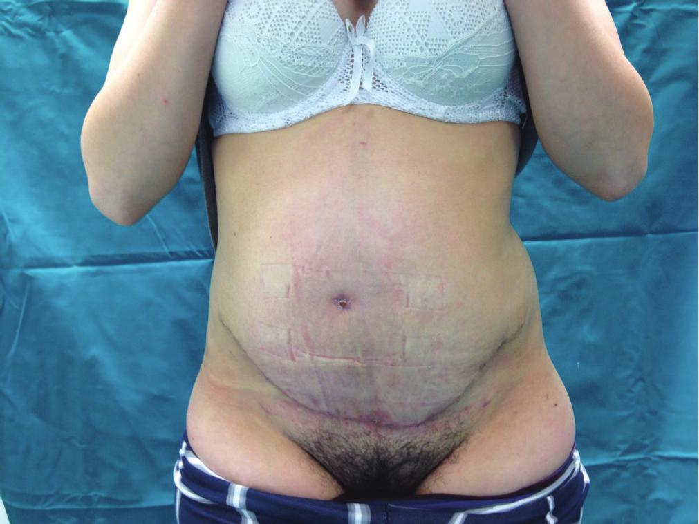 Similarly, prophylactic drains placement in abdominoplasty has been described as an attempt to reduce seroma formation [21 23].