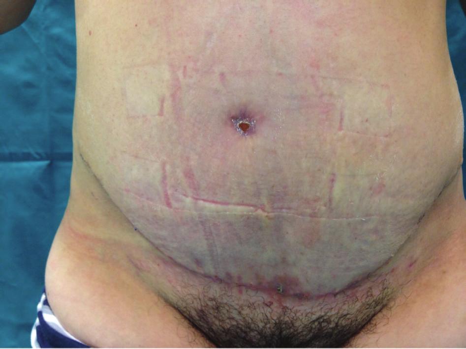 8% to 3% [24] of patients who have undergone abdominoplasty; however, the outcomes were more severe.