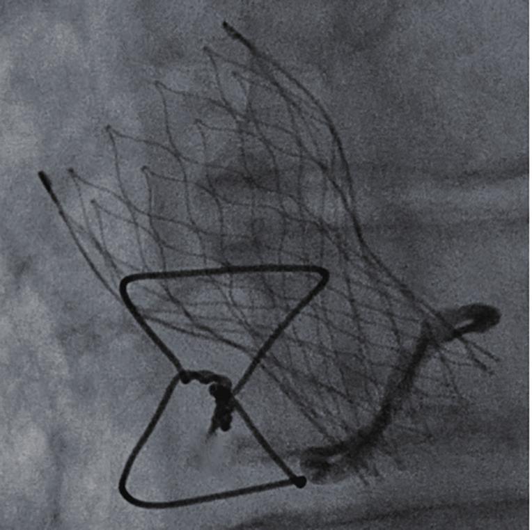 Mitral Valve-in-valve (10) Valve-in-ring (10) Mean age (years) 78.9 76.7 72.9 71.4 STS score 9.1% 9.0% 9.3% 8.1% Coronary obstruction 0.8% 0.9% LVOT obstruction 2.3% 2.3% Conversion to surgery 0.6% 0.