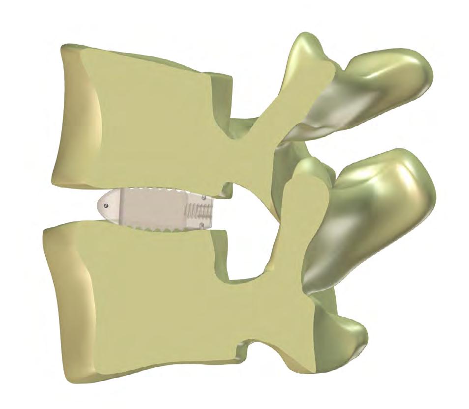 Before the second spacer is placed, the anterior and medial sides of the intervertebral space are filled with autogenous cancellous bone or with a bone substitute