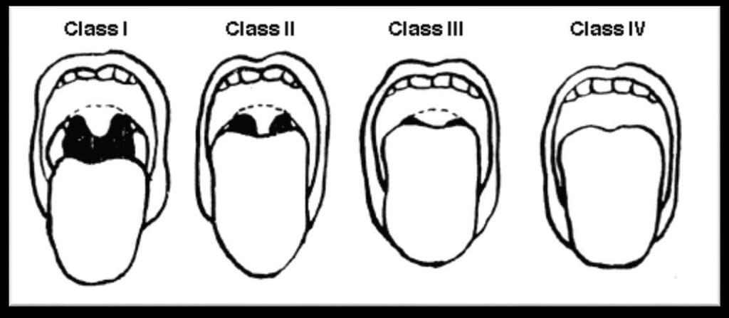 o Class III- only part of the uvula and soft