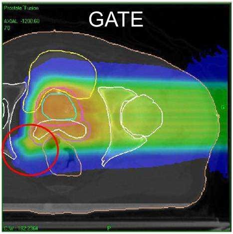 Radiotherapy ans Dosimetry TPS and GATE comparison patient