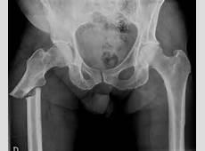 acid when compared to placebo Atypical femur fractures Calcitonin Brand name: Miacalcin or Fortical Treatment of