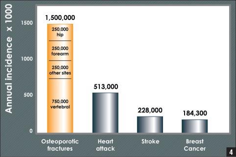Epidemiology of Osteoporosis Approximately 8 million women were estimated to have osteoporosis in 2010 Approximately 1 in 2 women over the age of 50 years will have an osteoporosis-related fracture