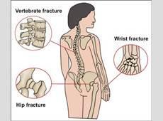 testing is typically performed 2 years after initiating therapy and every 2 years thereafter Medical Impact of Osteoporosis Most fracture in older adults are