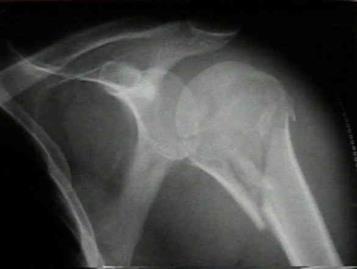 Risk Assessment A prior fracture at any skeletal site double future fracture risk Risk Assessment It is also important to evaluate risk factors for falling.