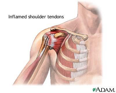 Shoulder Pain Tendonitis Tendon / Rotator cuff tear With