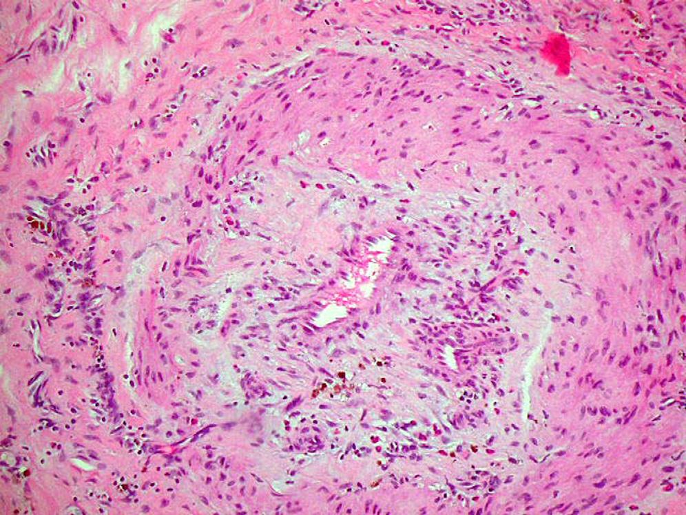 S220 LANGFORD J ALLERGY CLIN IMMUNOL FEBRUARY 2010 FIG 2. Medium-vessel vasculitis in a patient with PAN. glucocorticoid therapy and toxicity.