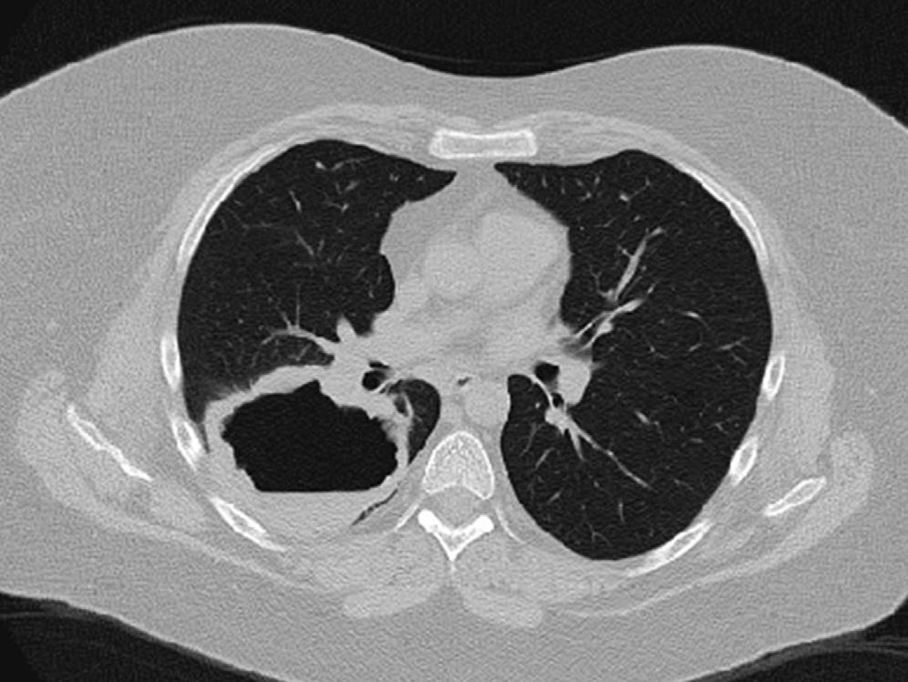 J ALLERGY CLIN IMMUNOL VOLUME 125, NUMBER 2 LANGFORD S221 FIG 3. A large cavitary lung nodule seen on a computed tomographic scan in a patient with WG. pauci-immune glomerulonephritis (Table III).