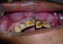 Intra-oral examination revealed firm, irregular, pinkish mass of approximately 8x5 cm, extending buccally from 13 to 27, and palatally involved the whole left hard palate and crossing the midline by