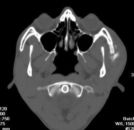 Figure 1(A): Axial plain CT in bone window settings showing erosion of left zygomatic