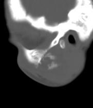 Figure 2(B): Sagital plain CT in bone window setting showing matrix calcification and soft