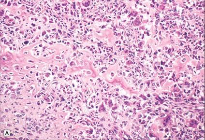 Extraskeletal Osteosarcoma Subtypes Osteoblastic Very cellular, highly pleomorphic tumor cells, numerous