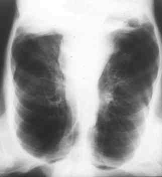 Mild COPD: Normal 1 choice: Chest x-ray Advanced COPD: