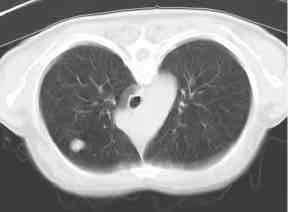 Single pulmonary nodule: Lung Cancer?