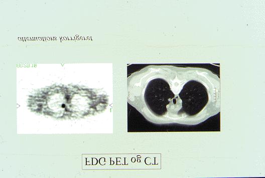 57 yr male COPD, 9 mm nodule 9 mm nodule