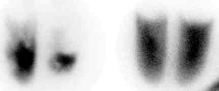 scintigraphy: